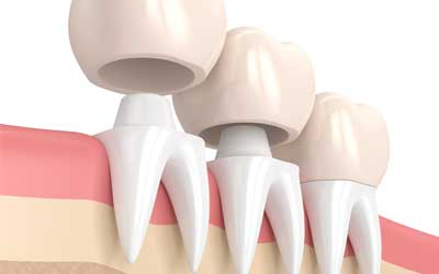 Dental Crowns 3D