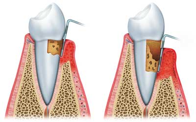 Damaged Teeth 2D